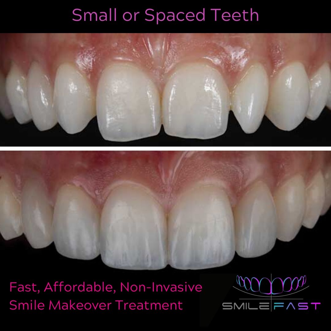 Small or spaced teeth